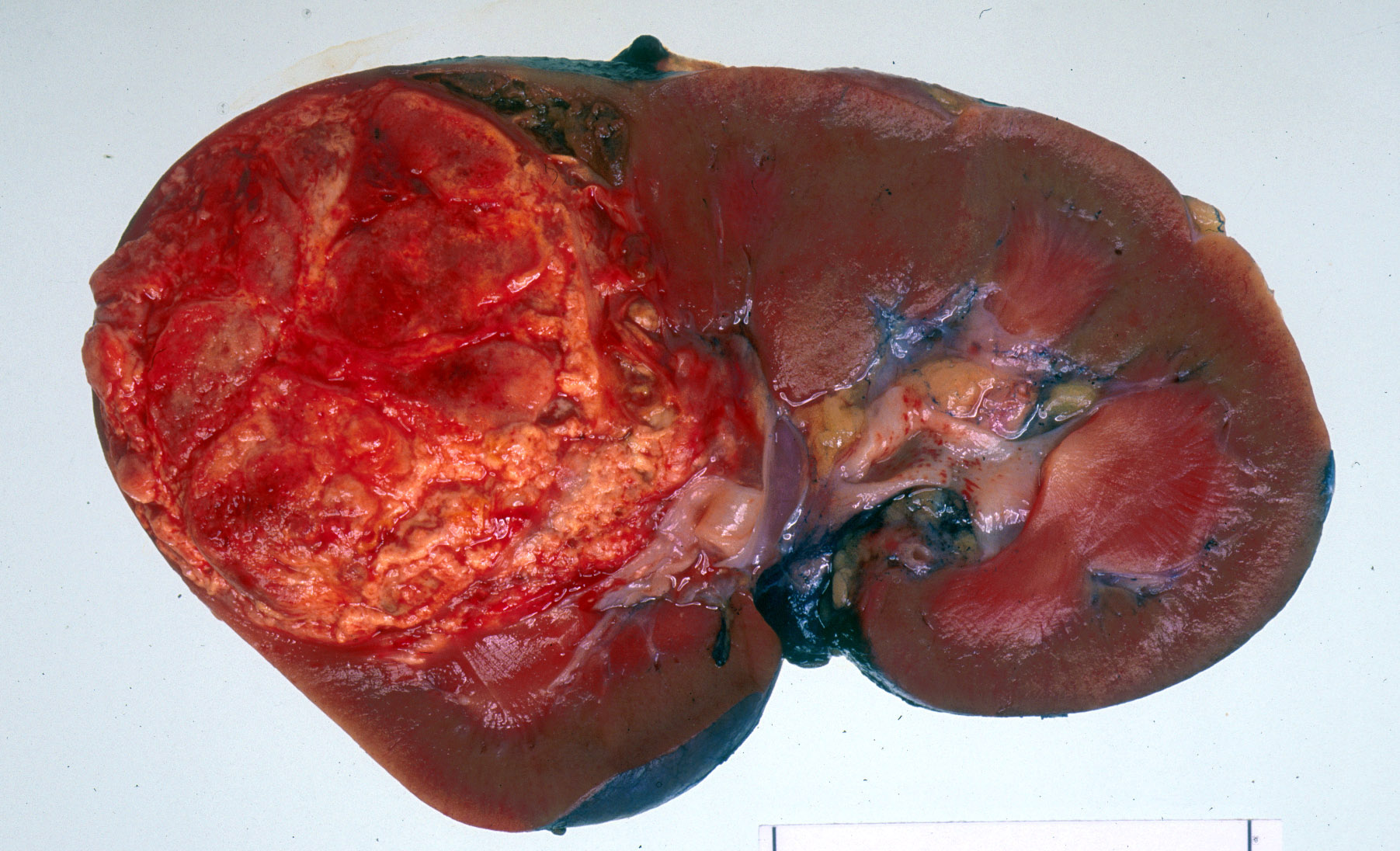 Renal Cancer MDT The British Association of Urological